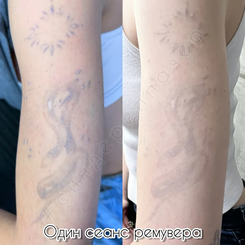 Синий пигмент на предплечье до и после